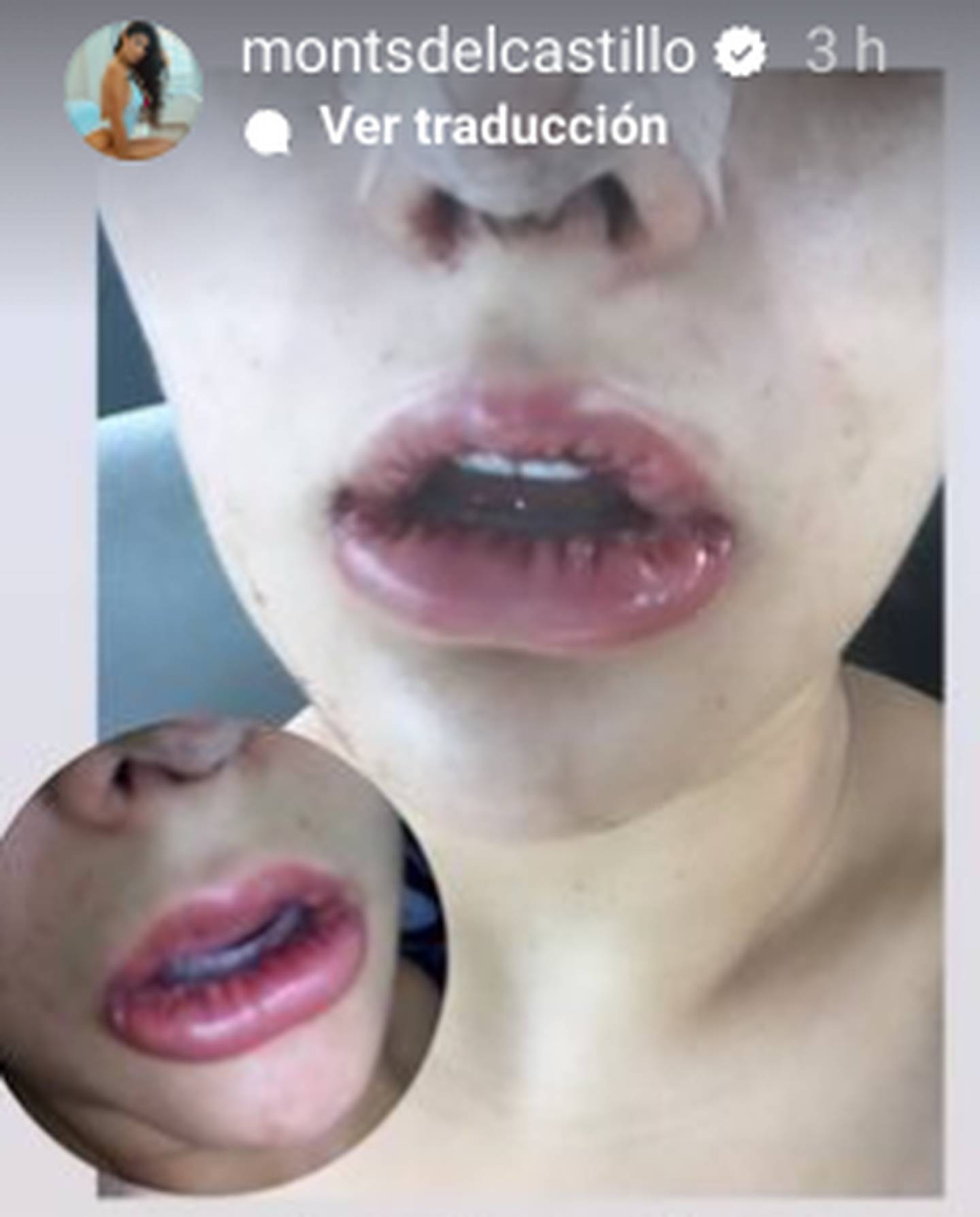 Montserrat Del Castillo y su ruda confesión sobre su cirugía estética en sus labios.